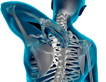 Manifestationen der Osteochondrose der Brustwirbelsäule
