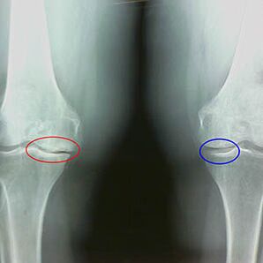 Arthrose des Kniegelenks am Röntgenbild