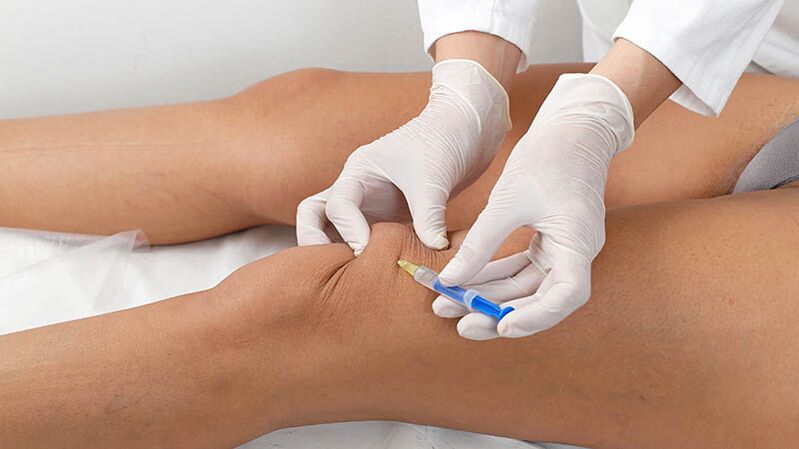 Intra -kartikuläre Injektion zur Arthrose des Knies