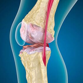 Übermäßige Spannung des Oberschenkelmuskels provoziert die Schmerzen im Knie