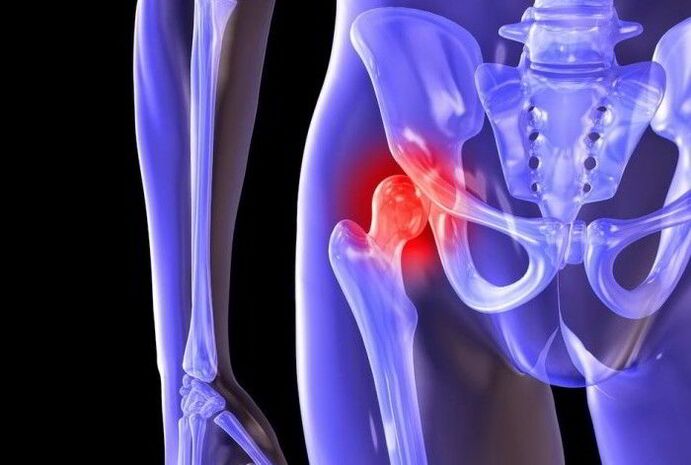 Pathologischer Prozess im Hüftgelenk mit Coxarthrose